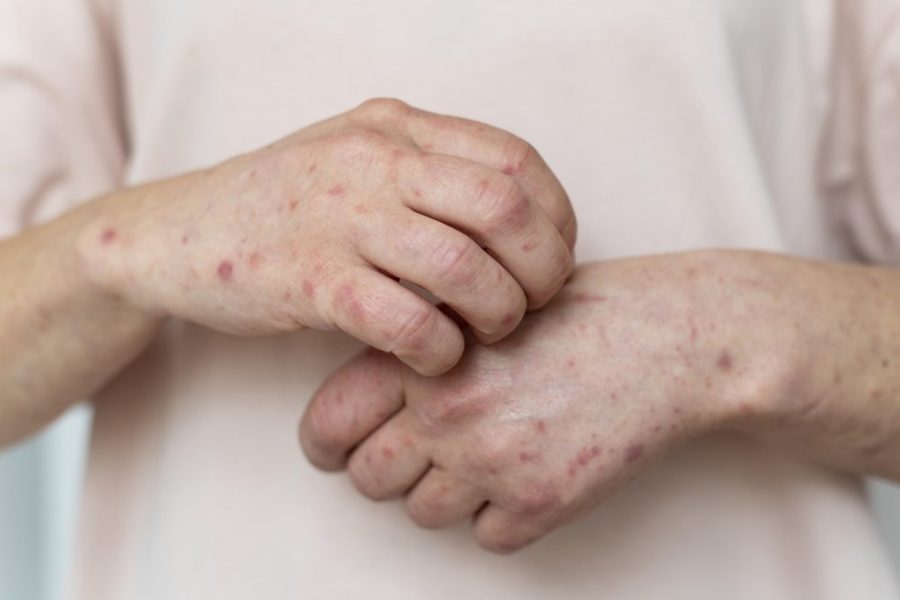 Mãos de pessoa com sintomas de varíola dos macacos — Foto: Divulgação/Prefeitura Municipal
