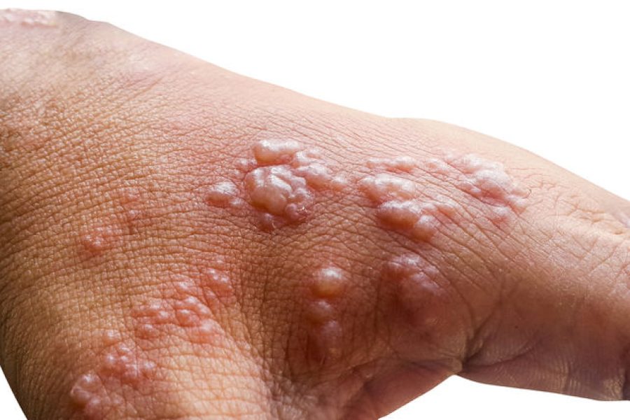 Skin infected Herpes zoster virus on the arms